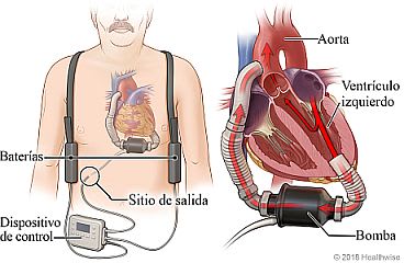Ubicación de la bomba del dispositivo de asistencia ventricular, los paquetes de batería y el controlador, con detalle del dispositivo de asistencia ventricular bombeando sangre del ventrículo izquierdo del corazón a la aorta.