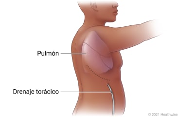 Vista lateral de una persona, que muestra un pulmón en el pecho y colocación de drenaje torácico al costado.