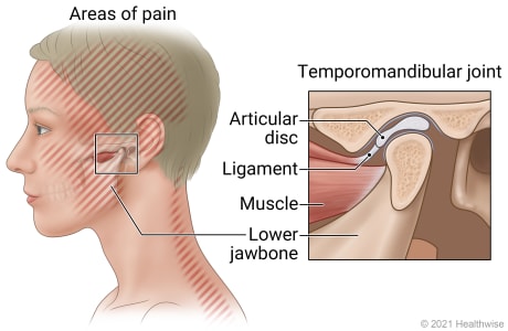 Zonas de dolor debido al trastorno temporomandibular, con detalle de la articulación TM que muestra el disco articular, el músculo y el maxilar inferior.