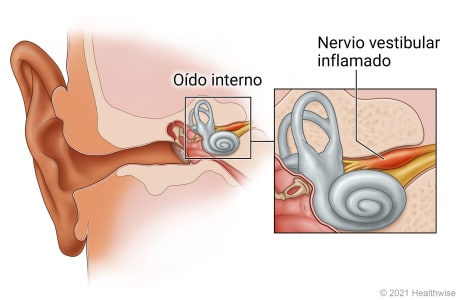 Oído interno, con detalle del nervio vestibular inflamado.