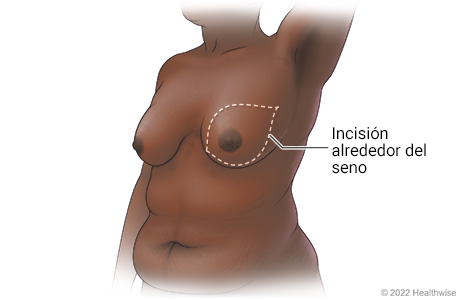 Seno, que muestra el contorno de la incisión alrededor del seno para la mastectomía.