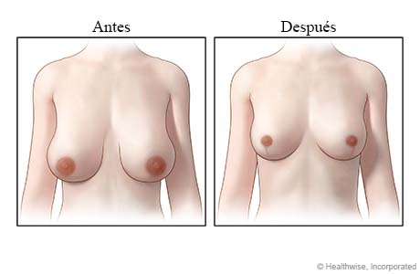 Vistas de senos, antes y después de una reducción de senos.