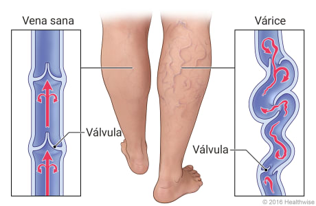 Vista externa de las piernas con y sin várices, con detalles de la vena sana y las várices retorcidas