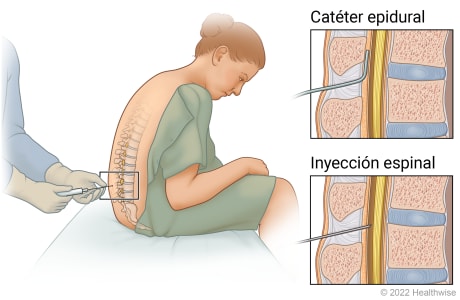 Aguja introducida cerca de la médula espinal en la espalda de una persona sentada, con detalles del sitio de la inyección raquídea y de la colocación del catéter epidural.