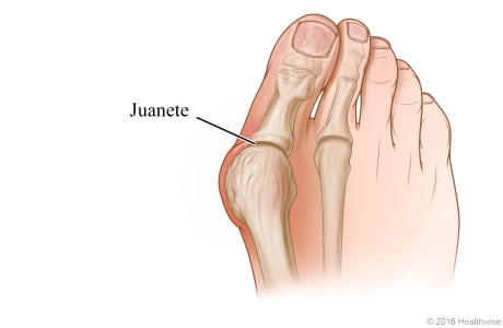Un juanete y la articulación en la base del dedo gordo del pie.