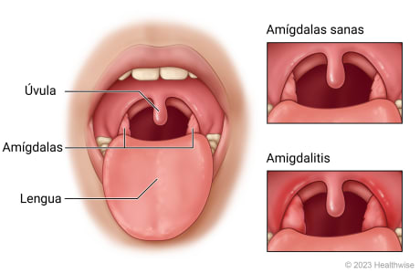 Boca abierta donde se muestran la úvula, las amígdalas y la lengua, con detalle de amígdalas sanas y amígdalas enrojecidas e hinchadas debido a una amigdalitis.