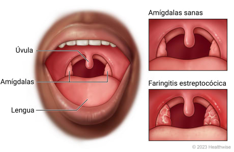 Boca abierta donde se muestran la garganta, la úvula, las amígdalas y la lengua, con detalle de amígdalas sanas y faringitis estreptocócica.
