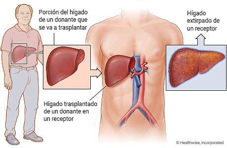 Trasplante de hígado de un donante vivo.