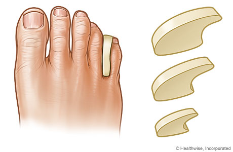 Diferentes tamaños de separadores de dedos de los pies y uno insertado entre dos dedos