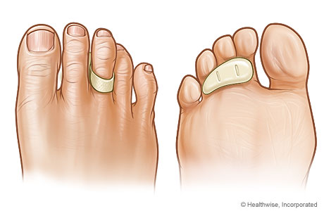 Almohadilla de cresta para los dedos tal como aparece en la parte superior y debajo de un dedo del pie