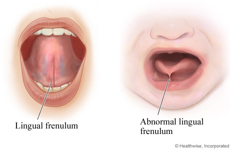 Imagen de un frenillo lingual normal y otro anormal