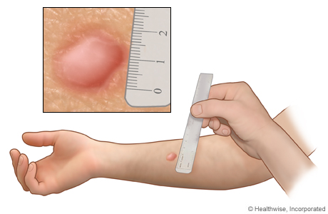 Medición de la reacción a una prueba de la tuberculina en la piel