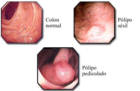 Fotos de pólipos de colon y un colon normal