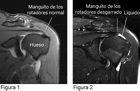 Imágenes de resonancia magnética de un desgarro del manguito de los rotadores