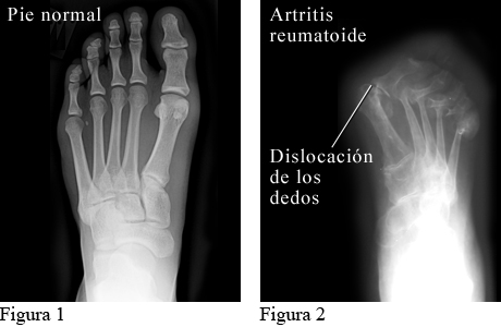 Radiografía de artritis reumatoide en los pies