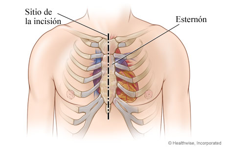 Lugar de la incisión en el tórax (pecho) en el centro y a lo largo del esternón