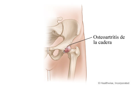 Articulación de la cadera afectada por osteoartritis