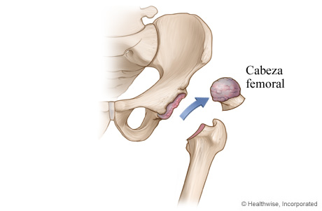 Artroplastia de cadera: Extracción de cartílago y hueso dañados
