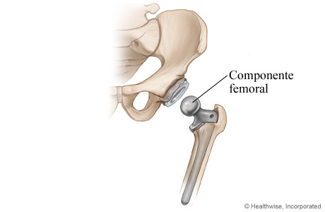 Artroplastia de cadera: Se coloca el componente femoral