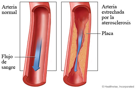Flujo sanguíneo en una arteria coronaria normal y flujo sanguíneo reducido en una arteria estrechada por la acumulación de placa