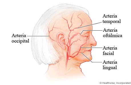 Arterias comúnmente afectadas por la arteritis de células gigantes