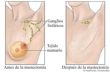 Antes y después de una mastectomía