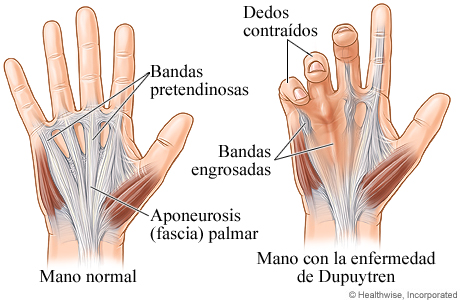 Imagen de mano normal y mano con enfermedad de Dupuytren