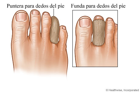 Una puntera en un dedo del pie y una funda en un dedo del pie