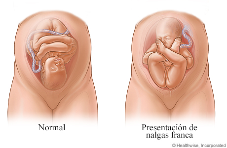 Imágenes de presentación normal y presentación de nalgas franca del feto