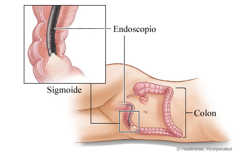 Sigmoidoscopio en el colon sigmoide