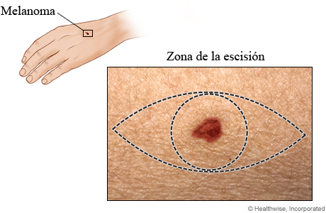 Zona de escisión del melanoma