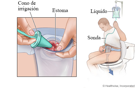 Irrigación de colostomía