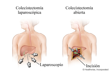 Cirugía laparoscópica y abierta para extirpar la vesícula biliar