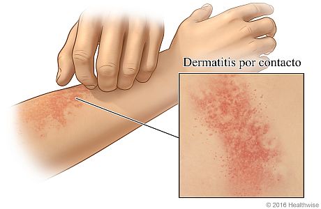 Dermatitis por contacto en un brazo, con detalle del salpullido