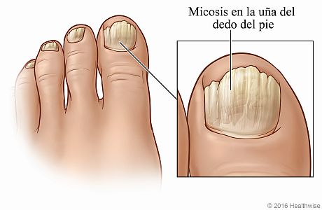 Uñas de los pies que muestran las señales de la micosis de uñas más común, con detalle del dedo gordo del pie