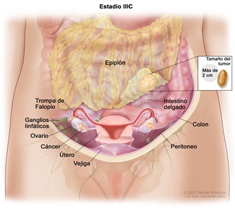 La figura del estadio IIIC muestra cáncer en el interior de ambos ovarios que se diseminó hasta el epiplón. El cáncer en el epiplón mide más de 2 cm. En un recuadro, se muestra que 2 cm es aproximadamente el tamaño de un maní (cacahuete). También se observa el intestino delgado, el colon, las trompas de Falopio, el útero, la vejiga y los ganglios linfáticos detrás del peritoneo.