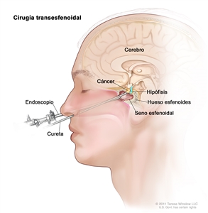 Cirugía transesfenoidal. En la imagen se observan un endoscopio y una cureta introducidos a través de la nariz y el seno esfenoidal para extirpar un cáncer de la hipófisis. También se muestra el hueso esfenoides.