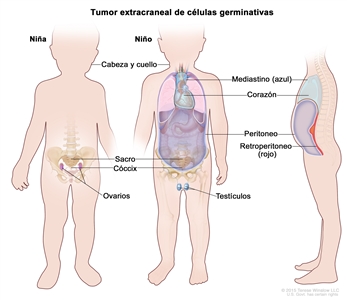 Tumor extracraneal de células germinativas. En la imagen se observan las partes del cuerpo adonde se pueden formar tumores extracraneales de células germinativas, que incluyen: la cabeza y el cuello, el mediastino (área entre los pulmones, que se muestra en azul), el retroperitoneo (área detrás de los órganos abdominales, que se muestra en rojo), el sacro, el cóccix, los testículos (en los niños) y los ovarios (en las niñas). También se muestran el corazón y el peritoneo.