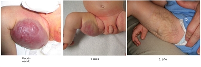 En la fotografía se observa un hemangioma cutáneo congénito en la cara interna del muslo derecho en un recién nacido (panel izquierdo), 1 mes después (panel central) y 1 año después (panel derecho).