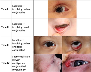 En las fotografías se observan tipos diferentes de hemangiomas infantiles que comprometen la conjuntiva.