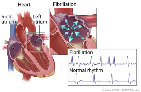 Right and left atria of heart with details showing fibrillation in an atrium, and EKG patterns of fibrillation and normal rhythm.