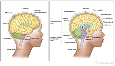 Anatomy of the brain; the right panel shows the supratentorial area (the upper part of the brain) and the posterior fossa/infratentorial area (the lower back part of the brain). The supratentorial area contains the cerebrum, lateral ventricle and third ventricle (with cerebrospinal fluid shown in blue), choroid plexus, pineal gland, hypothalamus, pituitary gland, and optic nerve. The posterior fossa/infratentorial area contains the cerebellum, tectum, fourth ventricle, and brain stem (midbrain, pons, and medulla). The spinal cord is also shown. The left panel shows the cerebrum, ventricles (fluid-filled spaces), meninges, skull, cerebellum, brain stem (pons and medulla), and spinal cord.