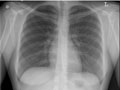 X-Ray of a Normal Chest