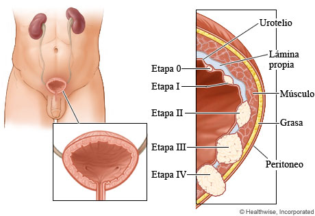 etapa 2 del cancer de pulmon