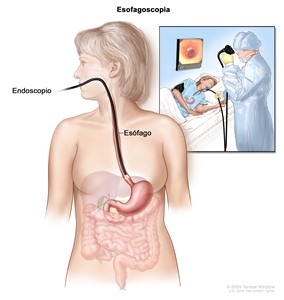 Esofagoscopia. Se introduce un endoscopio por la boca hasta el esófago. El recuadro muestra a la paciente en una camilla durante la esofagoscopia.