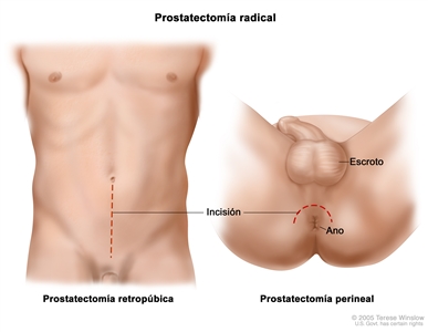 El dibujo a dos paneles muestra dos formas de hacer una prostatectomía radical; en el primer panel, la línea punteada muestra el lugar donde se hace la incisión a través de la pared del abdomen para realizar una prostatectomía retropúbica; en el segundo panel, la línea punteada muestra el lugar donde se hace la incisión entre el escroto y el ano para realizar una prostatectomía perineal.