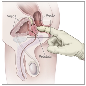Examen digital del recto; en la imagen se muestra una vista lateral de la anatomía del aparato reproductor y las vías urinarias en el hombre; se observan la próstata, el recto y la vejiga. También se muestra un dedo enguantado y lubricado que se introduce en el recto para palpar el recto, el ano y la próstata.
