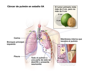 Cáncer de pulmón en estadio IIA. En la imagen se observa un tumor primario en el pulmón izquierdo que mide más de 4 cm, pero no más de 5 cm. Además se observan las siguientes situaciones: a) el cáncer se diseminó al bronquio principal izquierdo; b) el cáncer se diseminó a la membrana interna que recubre el pulmón (recuadro inferior); c) todo el pulmón o una parte de este se desinfló o presenta neumonitis (inflamación del pulmón). También se observan la carina y la pleura y, en el recuadro inferior, una costilla.