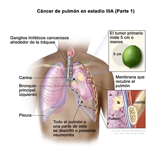 Cáncer de pulmón en estadio IIIA (Parte 1). En la imagen se observan un tumor primario que mide 5 cm o menos (recuadro superior) en el pulmón izquierdo y ganglios linfáticos cancerosos alrededor de la tráquea. También se observa lo siguiente: a) el cáncer se diseminó al bronquio principal izquierdo; b) el cáncer se diseminó a la membrana que recubre el pulmón (recuadro inferior); c) todo el pulmón o una parte de este se desinfló o presenta neumonitis (inflamación del pulmón). Además se muestran la carina, la pleura y en el recuadro inferior, una costilla.