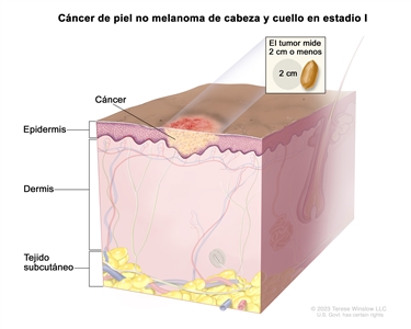 Cáncer de piel no melanoma de cabeza y cuello en estadio I. En el dibujo se observa cáncer en la epidermis (capa externa de la piel). En un recuadro se muestra que el tumor mide 2 cm o menos y que 2 cm es casi el tamaño de un maní. También se muestran la dermis (capa interna de la piel) y el tejido subcutáneo debajo de la dermis.